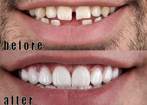 Vỏ 3 veneers sứ