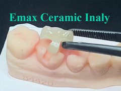 Emax Ceramic inlay được thiết kế chính xác cho vị trí được chỉ định