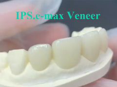 EMAX Veneer Giải pháp ý tưởng cho phục hồi răng bền và thẩm mỹ