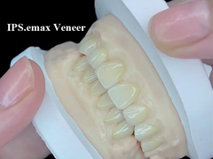 IPS.emax Veneer Giải pháp thẩm mỹ cao cấp cho sự biến đổi nụ cười tuyệt đẹp