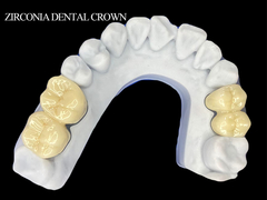 Vương miện răng Zirconia cho răng miệng