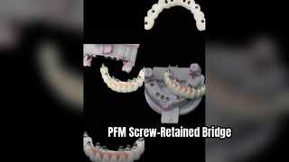 Phục hồi Implant được giữ bằng vít PFM chính xác