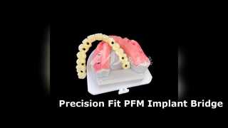 High Strength PFM Implant Bridge Precision Fit