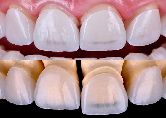 Mua Màn hình nha khoa EMAX lâu dài được chế tạo với tất cả các vật liệu Zirconia gốm online manufacture