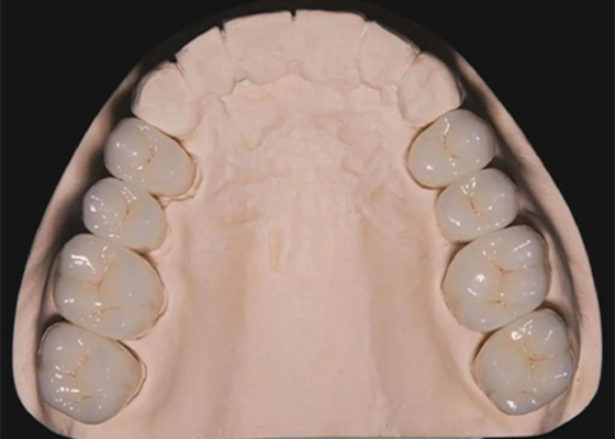 Mua Quá trình phục hồi răng răng Circonia vương miện răng được chế tạo bởi phòng thí nghiệm nha khoa Trung Quốc online manufacture
