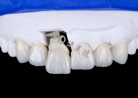 Mua Vương miện cấy ghép răng với vỏ Titanium cho nụ cười trông tự nhiên online manufacture