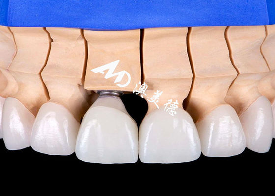 Mua Biocompatible Titanium Alloy Base Dental Implant Crown Bridge với vẻ ngoài thẩm mỹ tự nhiên online manufacture