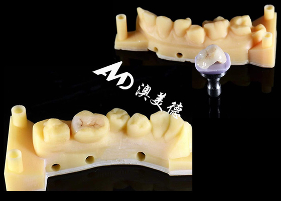 Mua Mượt mà Hypoallergenic Ceramic Inlays Onlays Tùy chỉnh phù hợp Kháng vết bẩn Độ bền cao online manufacture