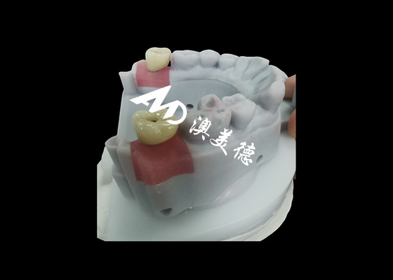 Mua Vương miện cấy ghép răng với trụ cột titan để phục hồi răng bền online manufacture