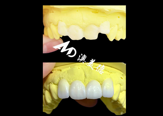 Mua Vương miện răng xuyên suốt Zirconia tùy chỉnh được chế tạo bởi AMD Dental Lab online manufacture