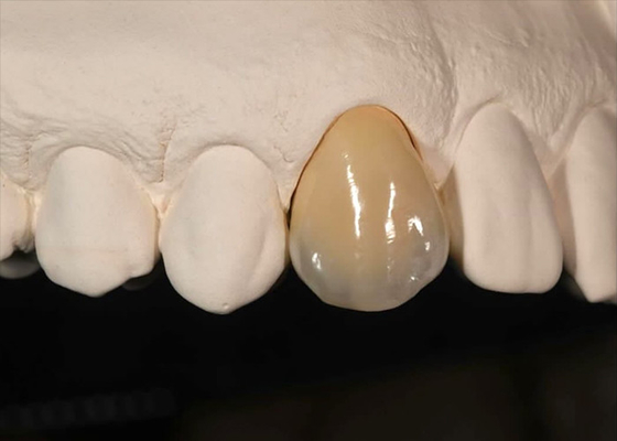 Mua Chống nhuộm màu Vương miện Zirconia rắn cho răng trước răng sau online manufacture