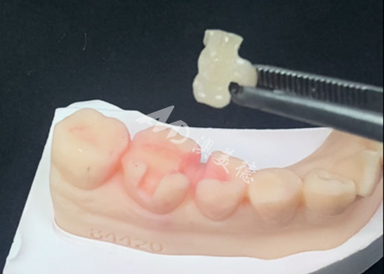 Mua Emax Ceramic Inlays Onlays Phục hồi răng cho màu răng tự nhiên online manufacture