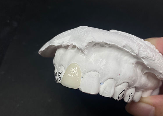 Giá tốt. Các tấm veneer nha khoa thông suốt tùy chỉnh là giải pháp nhanh và hiệu quả cho nụ cười lâu dài trực tuyến