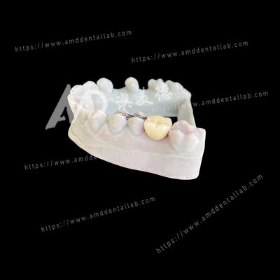 Mua PFM Maryland Bridge One Pontic Two Wings Một giải pháp bảo thủ và thẩm mỹ online manufacture