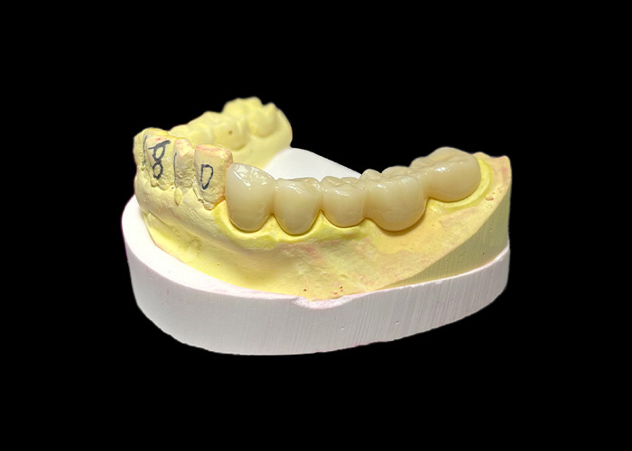 Vương miện răng bằng đồ sứ Zirconia cao cấp Sức mạnh không thể sánh kịp Chiết hợp chính xác và tính thẩm mỹ và độ bền đặc biệt