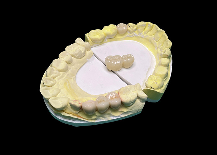 Vương miện và cây cầu gốm xuyên suốt tiên tiến làm tăng nụ cười của bạn với độ chính xác và thẩm mỹ tự nhiên cho độ bền lâu dài