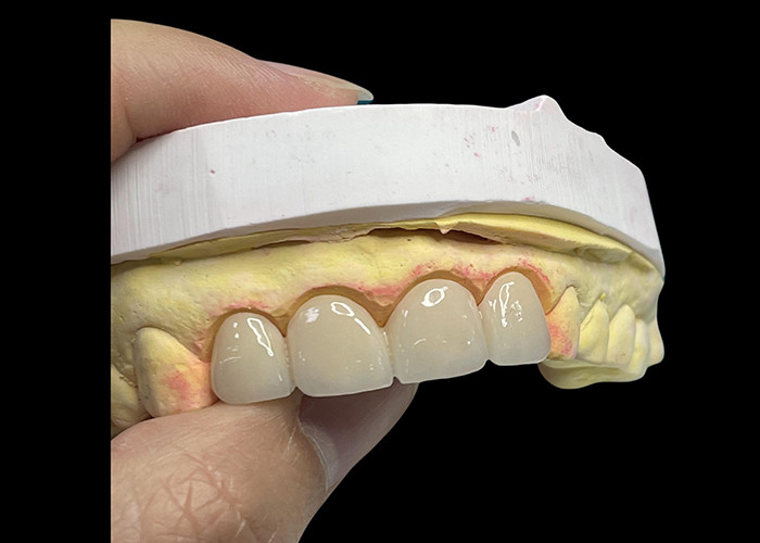 Vương miện và cây cầu gốm xuyên suốt tiên tiến làm tăng nụ cười của bạn với độ chính xác và thẩm mỹ tự nhiên cho độ bền lâu dài