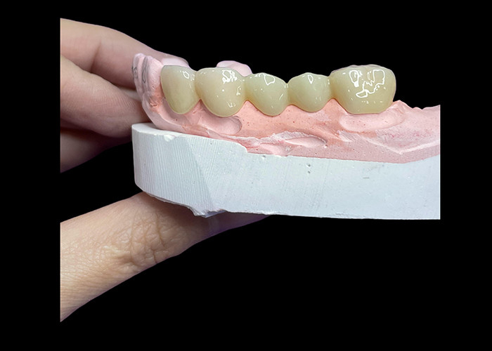 Tất cả các vương miện và cầu gạch gốm được thiết kế cho tính thẩm mỹ vượt trội độ bền và phù hợp tự nhiên cho sự tự tin lâu dài