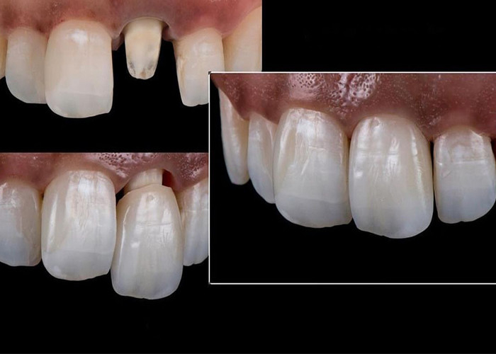 Tất cả các vương miện và cầu gạch gốm được thiết kế cho tính thẩm mỹ vượt trội độ bền và phù hợp tự nhiên cho sự tự tin lâu dài