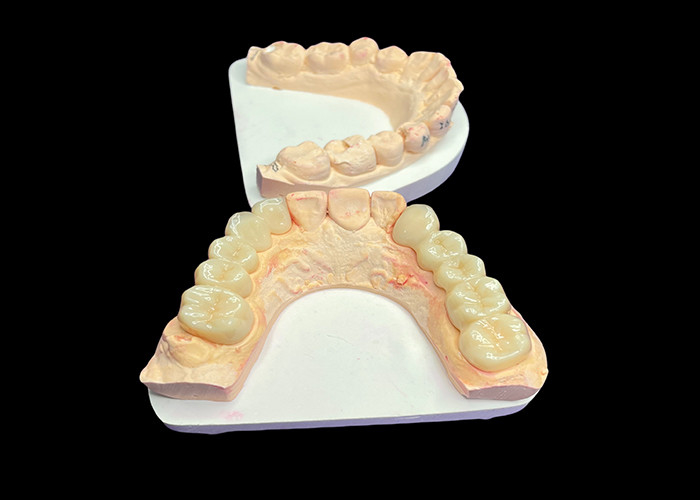 Vẻ đẹp tự nhiên Vương miện gốm trong suốt để phục hồi răng với việc làm sạch dễ dàng và kết quả lâu dài