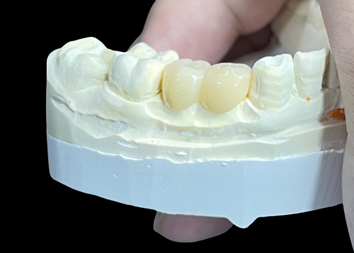 Kháng mòn bền được tùy chỉnh tất cả các vương miện và cầu gốm để phù hợp hoàn hảo và hiệu suất lâu dài