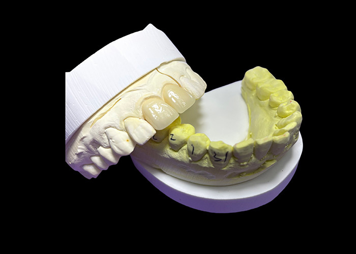 Kháng mòn bền được tùy chỉnh tất cả các vương miện và cầu gốm để phù hợp hoàn hảo và hiệu suất lâu dài