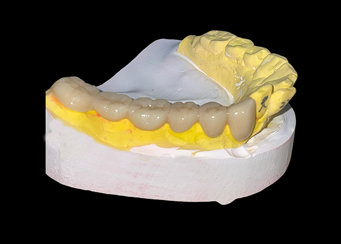 Kháng mòn bền được tùy chỉnh tất cả các vương miện và cầu gốm để phù hợp hoàn hảo và hiệu suất lâu dài