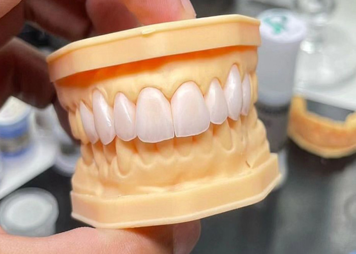 Cây cầu vương miện gốm đầy đủ sức mạnh với khả năng tương thích sinh học đặc biệt cho độ bền lâu dài