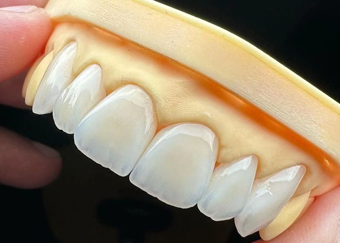Cây cầu vương miện gốm đầy đủ sức mạnh với khả năng tương thích sinh học đặc biệt cho độ bền lâu dài