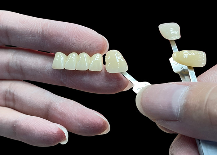 Chống vết bẩn tất cả các cầu sứ thoải mái phù hợp với phục hồi răng