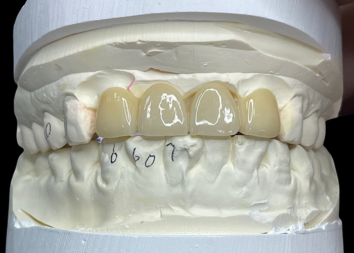 Chống vết bẩn tất cả các cầu sứ thoải mái phù hợp với phục hồi răng
