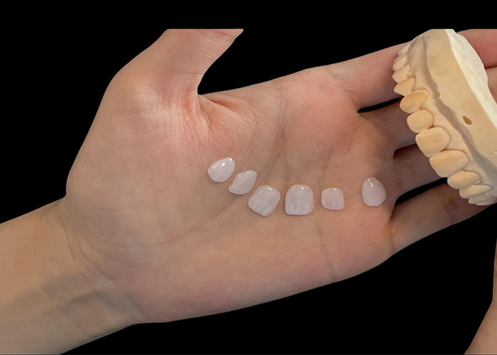Lớp porcelain Ultra Thin EMAX Veneers chống vết bẩn cho việc khôi phục thẩm mỹ