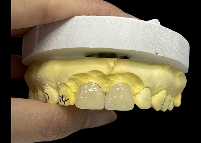 Lớp porcelain Ultra Thin EMAX Veneers chống vết bẩn cho việc khôi phục thẩm mỹ