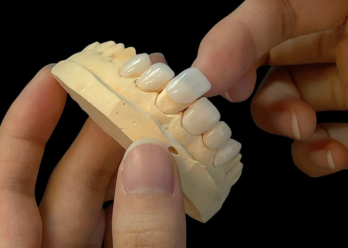 Lớp porcelain Ultra Thin EMAX Veneers chống vết bẩn cho việc khôi phục thẩm mỹ