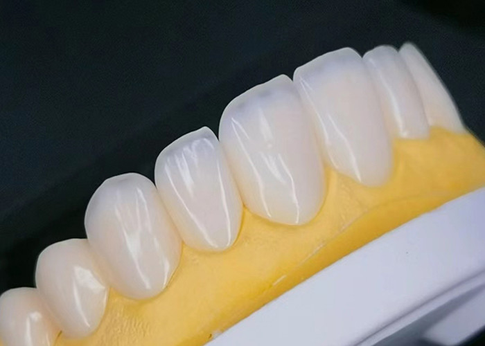 EMAX Porcelain Veneer với khả năng chống vết bẩn cho việc phục hồi thẩm mỹ trông tự nhiên