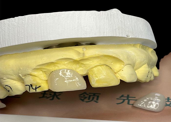 EMAX Porcelain Veneer với khả năng chống vết bẩn cho việc phục hồi thẩm mỹ trông tự nhiên