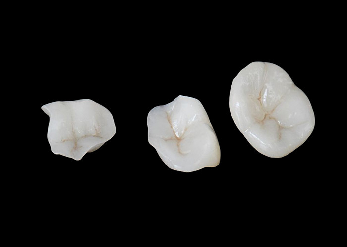 Biocompatible Ceramic Inlays và Onlays được thiết kế để thoải mái bền và tích hợp liền mạch với răng tự nhiên