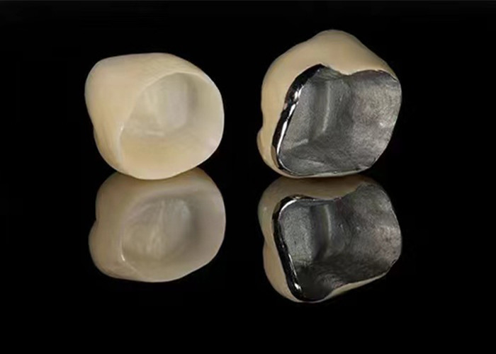 Đồ xốp trông tự nhiên được hợp nhất với vương miện kim loại để phục hồi răng bị hư hỏng