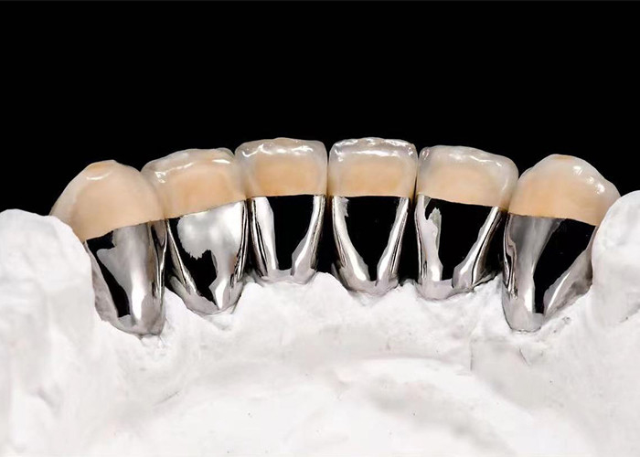 Đồ xốp trông tự nhiên được hợp nhất với vương miện kim loại để phục hồi răng bị hư hỏng