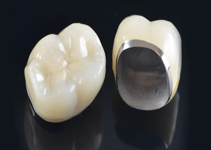 Đồ xốp trông tự nhiên được hợp nhất với vương miện kim loại để phục hồi răng bị hư hỏng