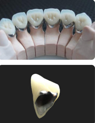 Đồ xốp hợp kim với kim loại PFM Vương miện chống mòn răng cho nha khoa phục hồi