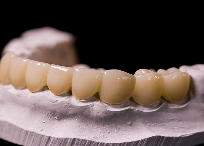 Đồ xốp hợp kim với vương miện kim loại - Công nghệ tiên tiến để phục hồi nụ cười lâu dài