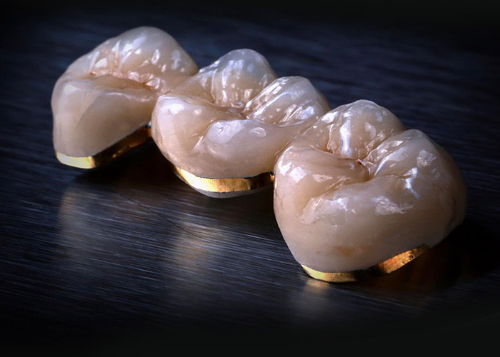 Đồ xốp hợp kim với vương miện kim loại - Công nghệ tiên tiến để phục hồi nụ cười lâu dài