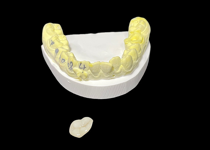 Các lớp phủ gốm và lớp phủ gốm nha khoa tùy chỉnh cho các giải pháp phục hồi và sửa chữa răng bị hư