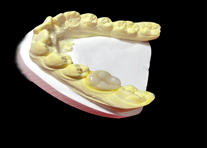 Các lớp phủ gốm và lớp phủ gốm chất lượng cao để phục hồi răng liền mạch và lâu dài