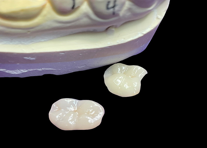 IPS e.max Các lớp phủ và lớp phủ gốm để phục hồi hàm răng miệng