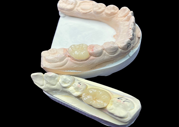 IPS e.max Các lớp phủ và lớp phủ gốm để phục hồi hàm răng miệng