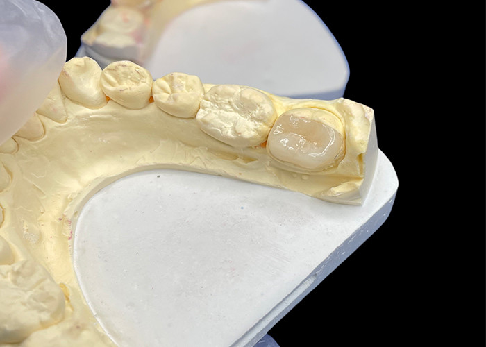 IPS e.max Các lớp phủ và lớp phủ gốm để phục hồi hàm răng miệng