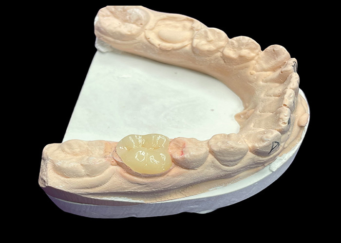 Custom Smooth Dental Ceramic Inlay cho nhuộm chống mờ sửa chữa răng liền mạch và thẩm mỹ tự nhiên