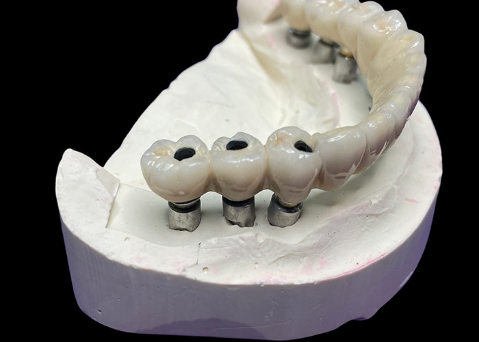 Chiếc cấy ghép răng có nền bằng titan được phủ một cây cầu vương miện gốm đẹp để tạo ra một sự phục hồi hoàn hảo.
